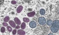 Ministerio de Salud emite despacho urgente sobre la detección del primer caso de viruela símica