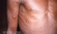 WHO holds emergency meeting on monkeypox