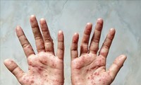 US CDC urges Vietnam's monkeypox response preparedness