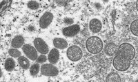 L’OMS demande l’aide du public pour renommer la “variole du singe“