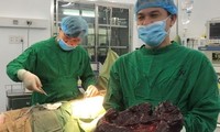 Phẫu thuật cắt khối u lá lách “khủng” có trọng lượng 5kg