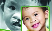 Free surgeries for children with deformities in Ninh Thuan province