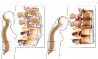 Cách điều trị đối với chứng đau lưng cấp và đau lưng mãn tính