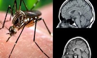 Confirman el primer caso importado de zika en embarazada en Europa 
