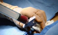 VN làm chủ phương pháp ghép tế bào gốc tạo máu 