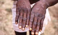 Vietnam increases vigilance to prevent monkeypox from entering the country