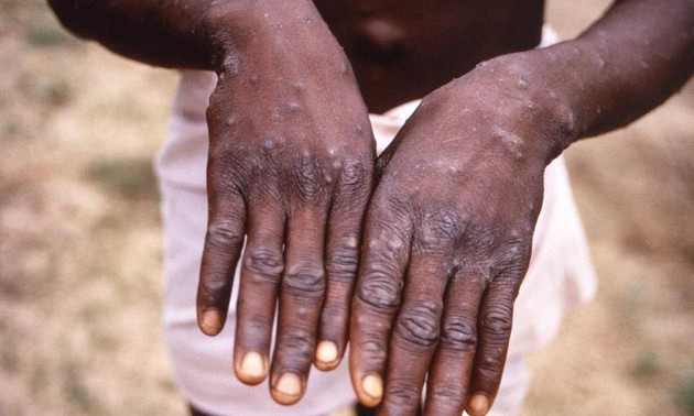 Monkeypox sera renommé mpox pour éviter la stigmatisation, annonce l’OMS