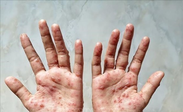 Le Vietnam et les États-Unis coopèrent dans la lutte contre la variole du singe