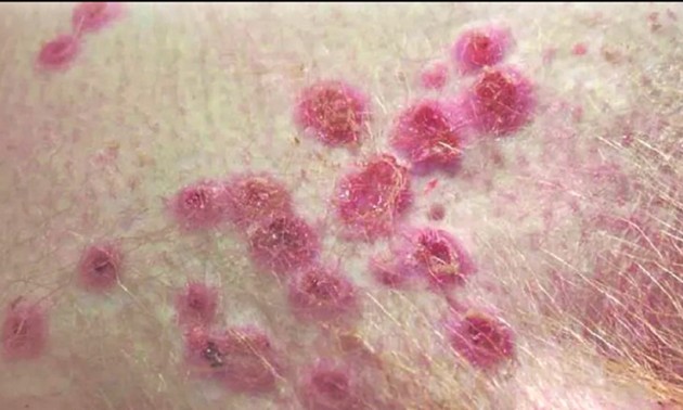  中国爆发猴痘疫情，确诊病例已超过100例