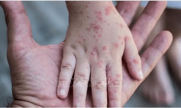 Monkeypox spreads to 30 countries