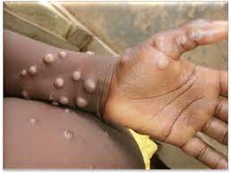 Les États-Unis comptent le plus de cas de variole du singe au monde