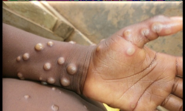 Ministry of Health orders monitoring of suspected Monkeypox cases at border