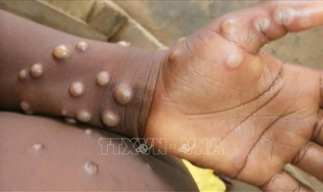 WHO confirms 780 monkeypox cases in 27 countries