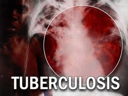 Diputados aportan opiniones sobre políticas de prevención contra la tuberculosis