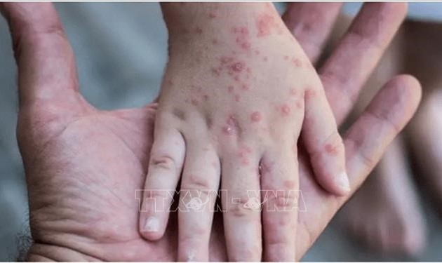 OMS: la variole du singe ne pose pas de risque grave pour la santé publique au niveau mondial