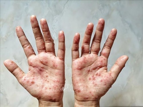 Le Vietnam et les États-Unis coopèrent dans la lutte contre la variole du singe - ảnh 1