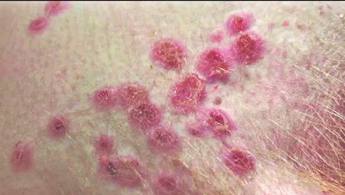  中国爆发猴痘疫情，确诊病例已超过100例 - ảnh 1