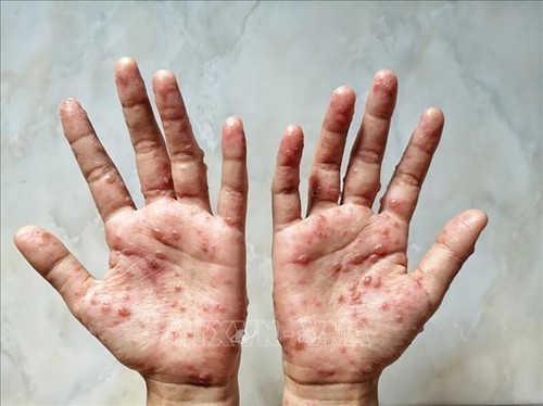 Ministry of Health advises people to take precautions against monkeypox - ảnh 1