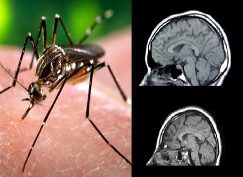 Confirman el primer caso importado de zika en embarazada en Europa  - ảnh 1