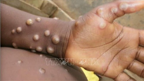 El mundo sigue reportando nuevos casos de viruela símica - ảnh 1