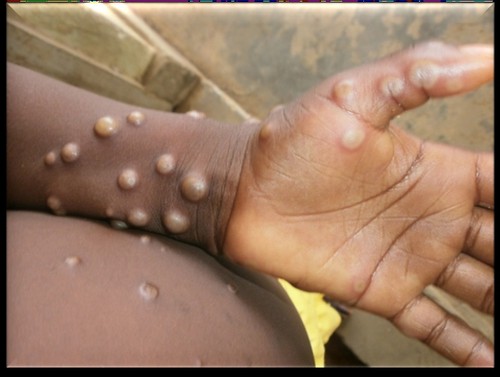 Ministry of Health orders monitoring of suspected Monkeypox cases at border - ảnh 1