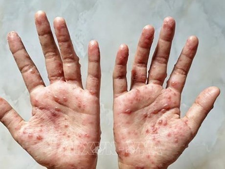 Health Ministry recommends measures to prevent monkeypox - ảnh 1