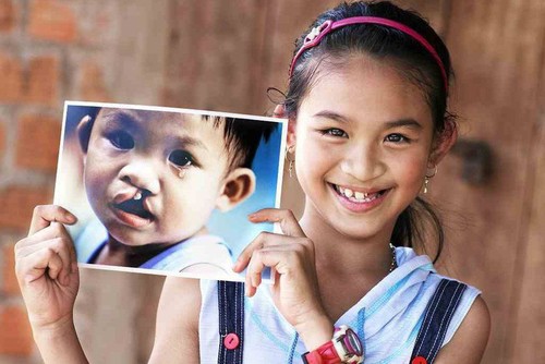 Công bố Quỹ Nụ cười với 500 suất mổ hàm ếch cho trẻ em Việt Nam - ảnh 1