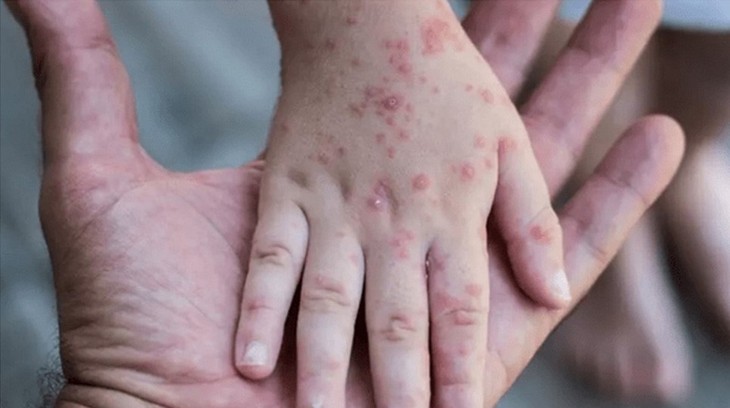 Monkeypox cases spread to 78 countries - ảnh 1
