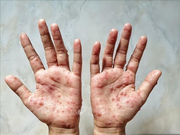US CDC urges Vietnam's monkeypox response preparedness - ảnh 1