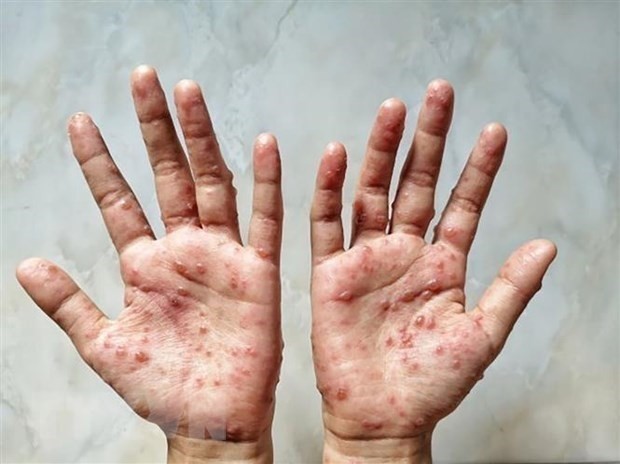 Government urges greater effort to prevent monkeypox  - ảnh 1