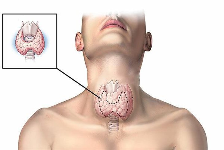 Những thực phẩm hỗ trợ giảm cân do tuyến giáp mất cân bằng - ảnh 1