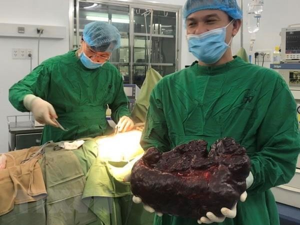 Phẫu thuật cắt khối u lá lách “khủng” có trọng lượng 5kg - ảnh 1