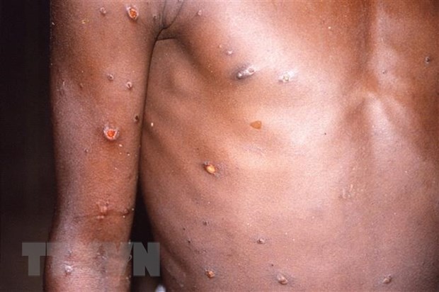 คณะกรรมการที่ปรึกษาขององค์การอนามัยโลกจัดการประชุมฉุกเฉินเกี่ยวกับโรคฝีดาษลิง (Monkeypox) - ảnh 1