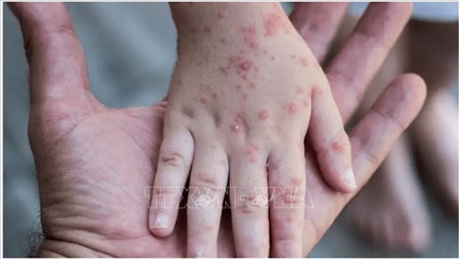 OMS: la variole du singe ne pose pas de risque grave pour la santé publique au niveau mondial - ảnh 1